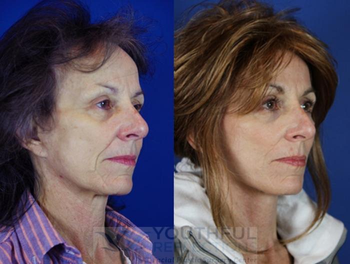 Facelift / Reflection Lift Case 22 Before & After Right Oblique | Nashville, TN | Youthful Reflections