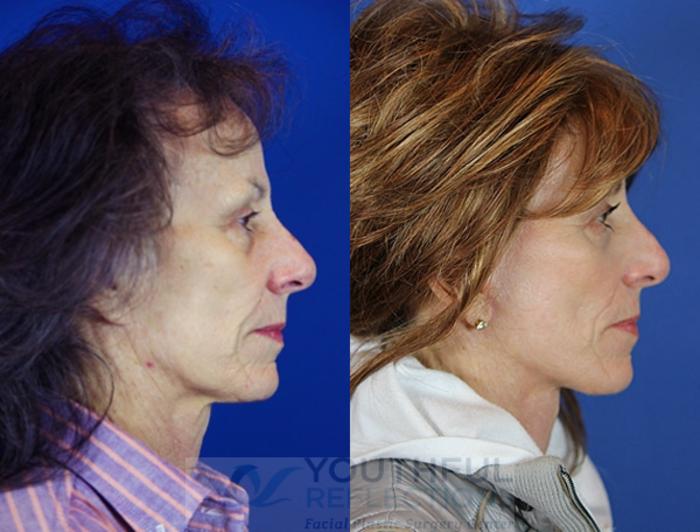Facelift / Reflection Lift Case 22 Before & After Right Side | Nashville, TN | Youthful Reflections