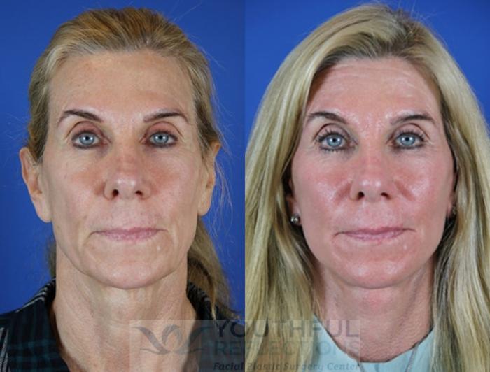 Facelift / Reflection Lift Case 23 Before & After Front | Nashville, TN | Youthful Reflections