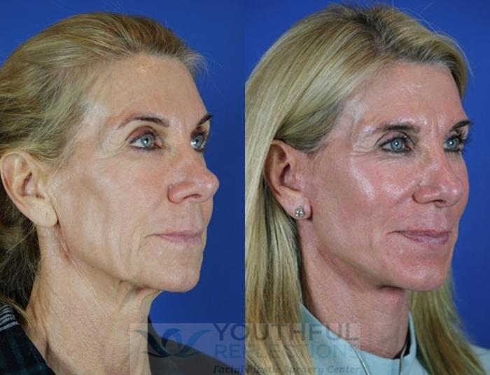 Facelift / Reflection Lift Case 23 Before & After Right Oblique | Nashville, TN | Youthful Reflections