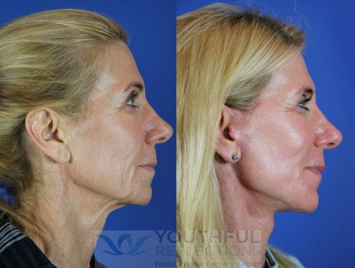 Facelift / Reflection Lift Case 23 Before & After Right Side | Nashville, TN | Youthful Reflections