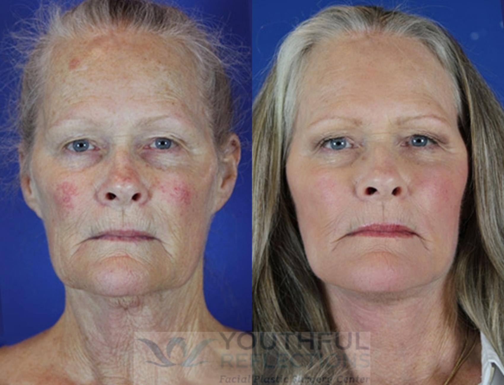 Facelift / Reflection Lift Case 24 Before & After Front | Nashville, TN | Youthful Reflections