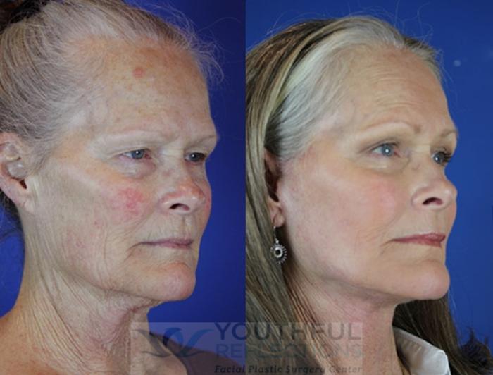 Facelift / Reflection Lift Case 24 Before & After Right Oblique | Nashville, TN | Youthful Reflections