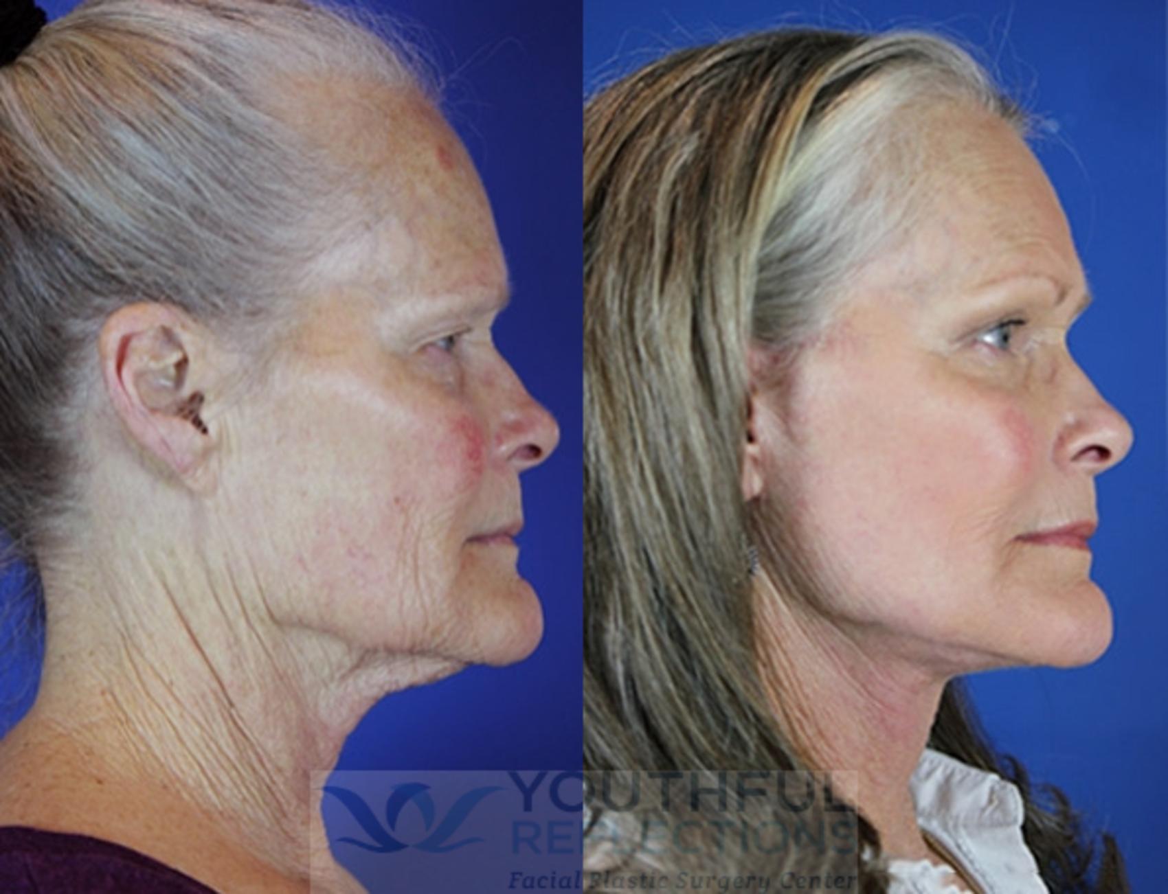 Facelift / Reflection Lift Case 24 Before & After Right Side | Nashville, TN | Youthful Reflections