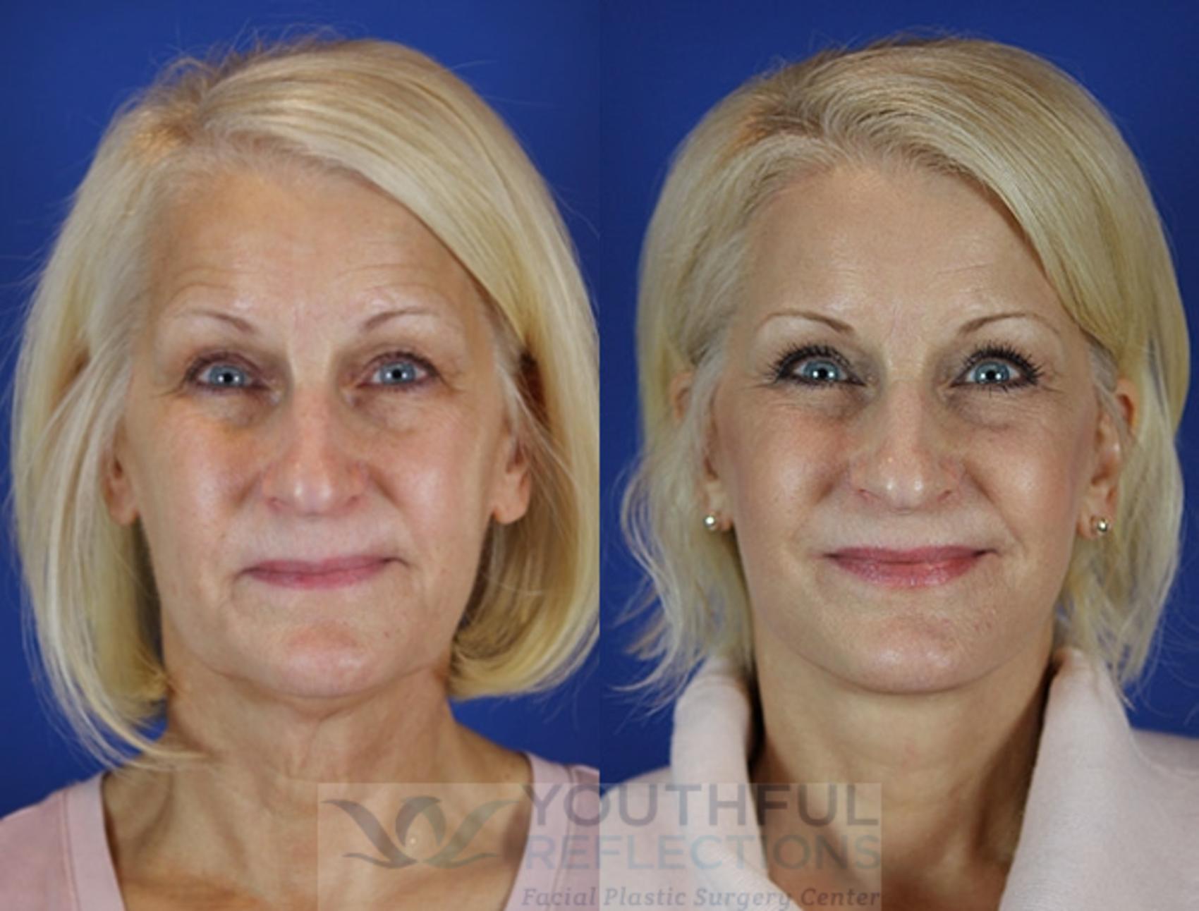 Brow Lift Case 25 Before & After Front | Nashville, TN | Youthful Reflections