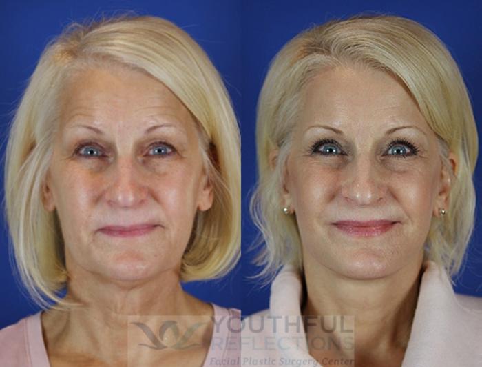 Facelift / Reflection Lift Case 25 Before & After Front | Nashville, TN | Youthful Reflections