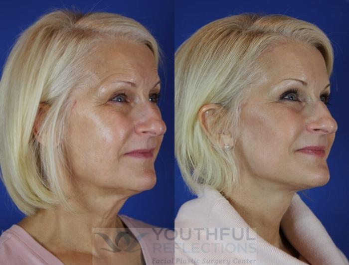 Facelift / Reflection Lift Case 25 Before & After Right Oblique | Nashville, TN | Youthful Reflections