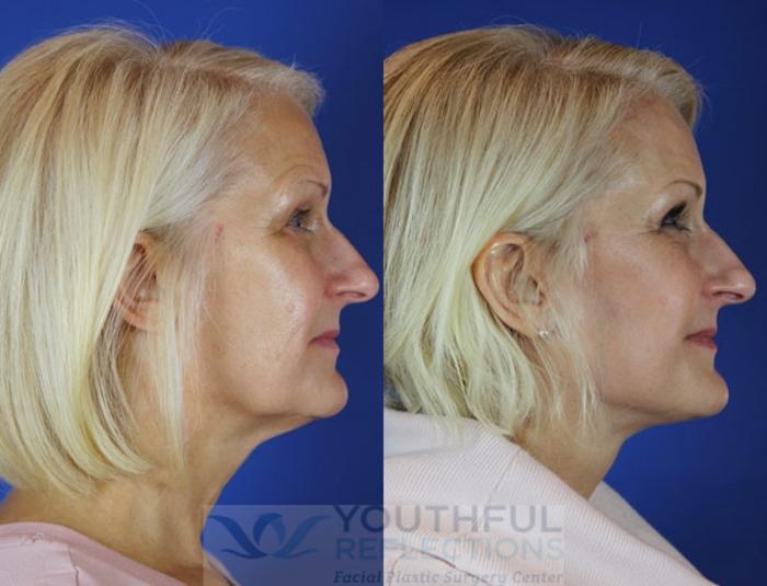 Facelift / Reflection Lift Case 25 Before & After Right Side | Nashville, TN | Youthful Reflections