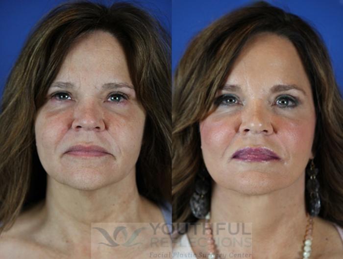 Facelift / Reflection Lift Case 26 Before & After Front | Nashville, TN | Youthful Reflections