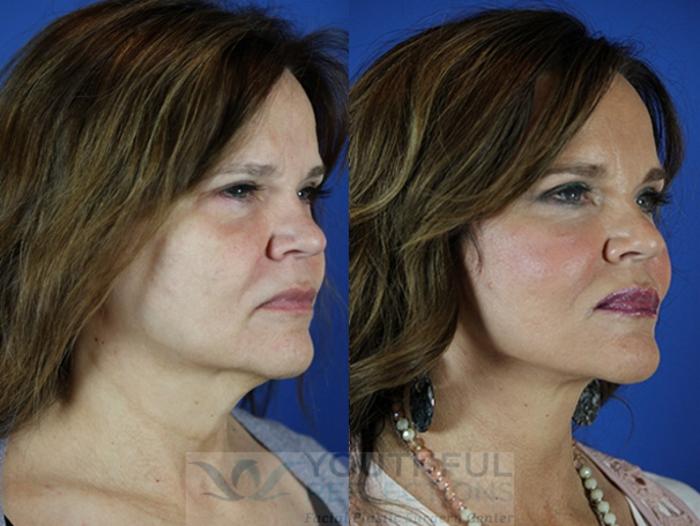 Facelift / Reflection Lift Case 26 Before & After Right Oblique | Nashville, TN | Youthful Reflections