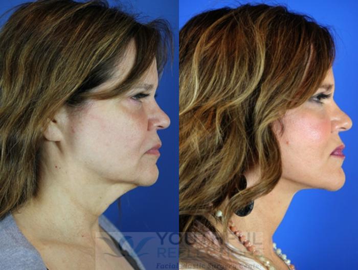 Facelift / Reflection Lift Case 26 Before & After Right Side | Nashville, TN | Youthful Reflections