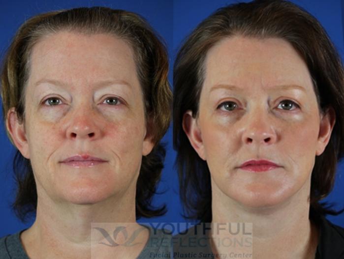 Facelift / Reflection Lift Case 27 Before & After Front | Nashville, TN | Youthful Reflections