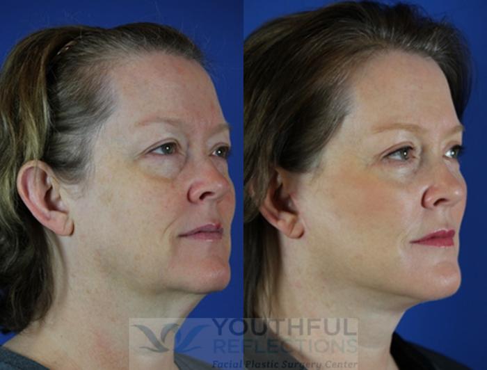 Facelift / Reflection Lift Case 27 Before & After Right Oblique | Nashville, TN | Youthful Reflections