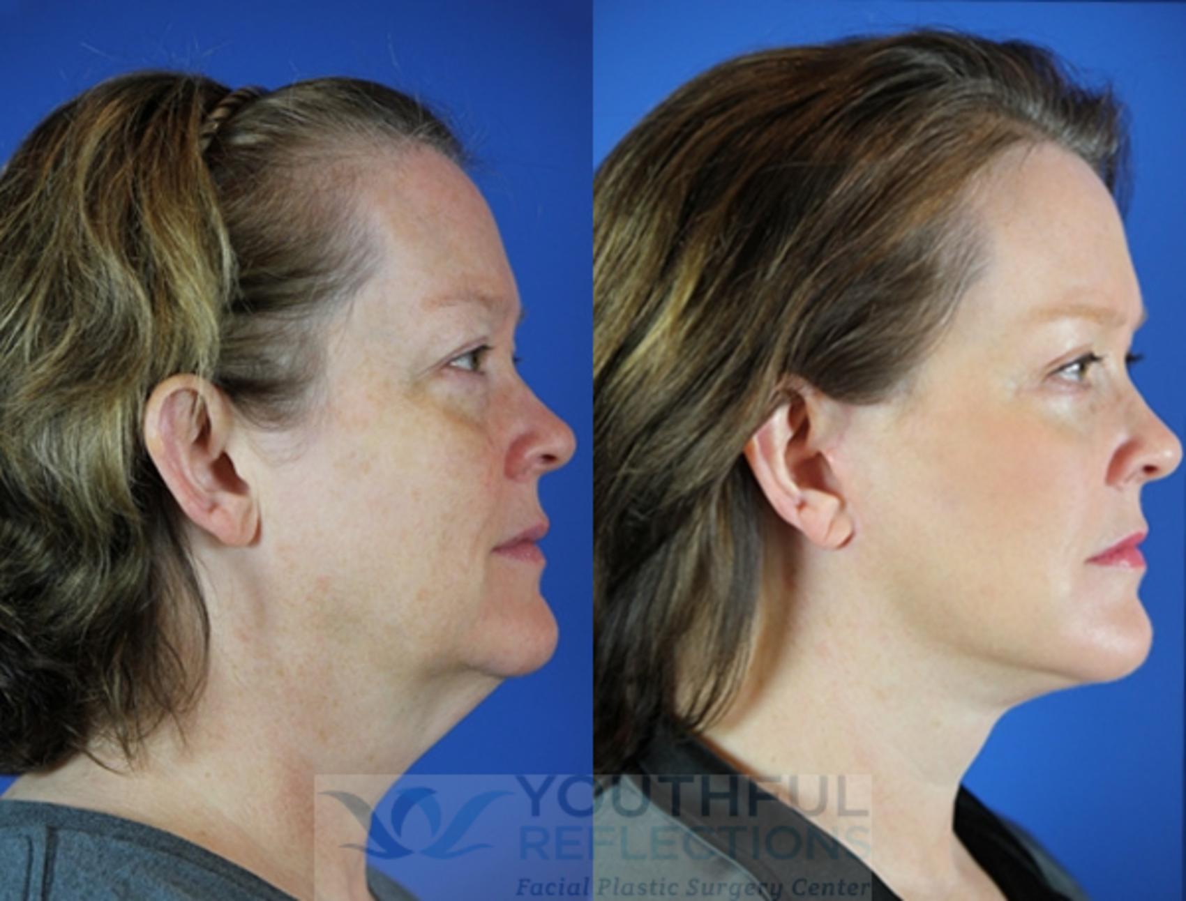 Facelift / Reflection Lift Case 27 Before & After Right Side | Nashville, TN | Youthful Reflections