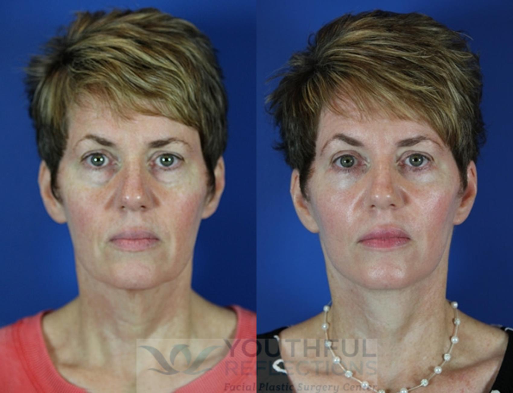 Facelift / Reflection Lift Case 28 Before & After Front | Nashville, TN | Youthful Reflections