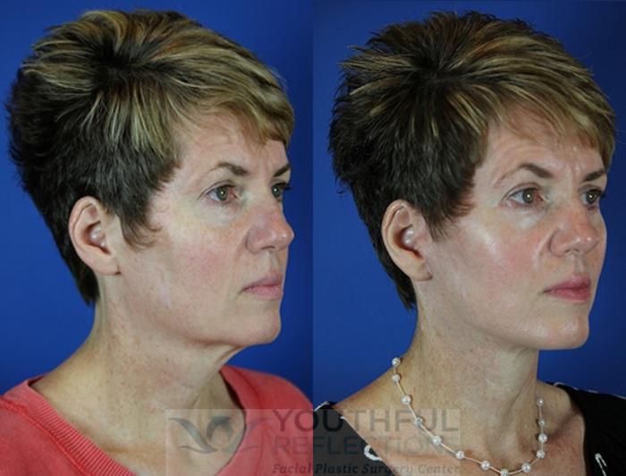 Lower Blepharoplasty Case 28 Before & After Right Oblique | Nashville, TN | Youthful Reflections