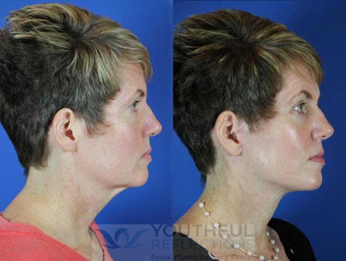 Facelift / Reflection Lift Case 28 Before & After Right Side | Nashville, TN | Youthful Reflections