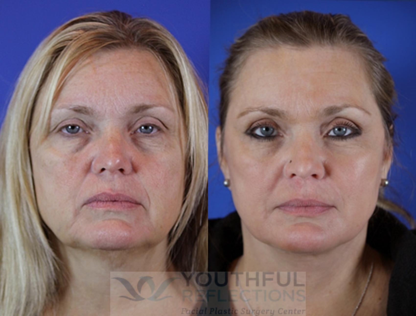 Facelift / Reflection Lift Case 29 Before & After Front | Nashville, TN | Youthful Reflections