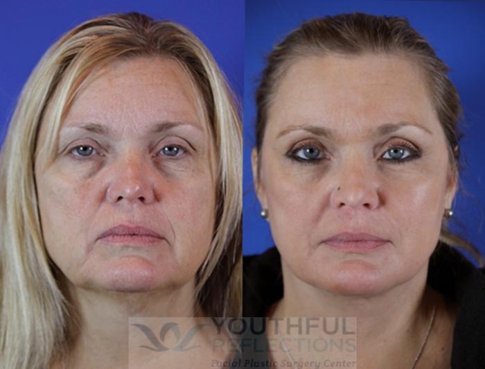 CO2 Laser Skin Resurfacing Case 29 Before & After Front | Nashville, TN | Youthful Reflections
