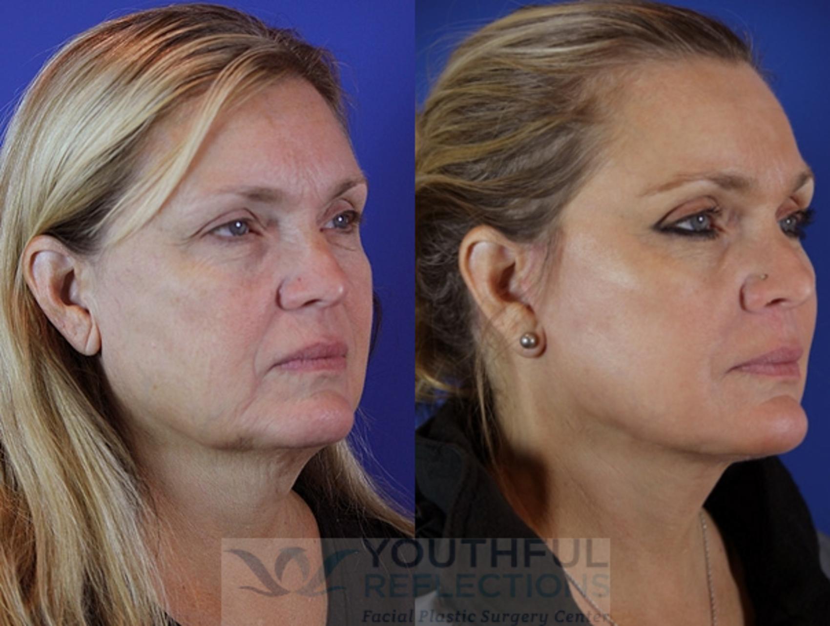 CO2 Laser Skin Resurfacing Case 29 Before & After Right Oblique | Nashville, TN | Youthful Reflections