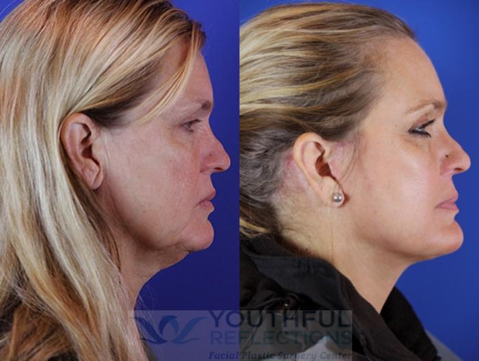 Facelift / Reflection Lift Case 29 Before & After Right Side | Nashville, TN | Youthful Reflections