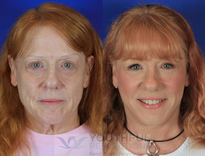 Facelift / Reflection Lift Case 3 Before & After Front | Nashville, TN | Youthful Reflections