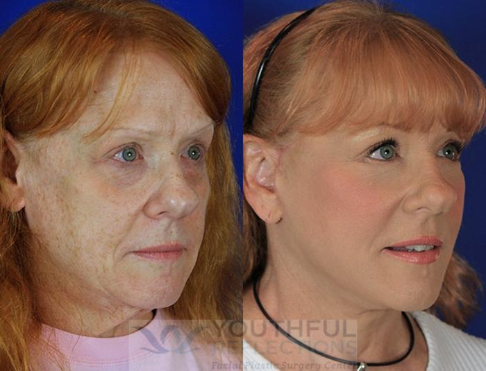 Lower Blepharoplasty Case 3 Before & After Right Oblique | Nashville, TN | Youthful Reflections