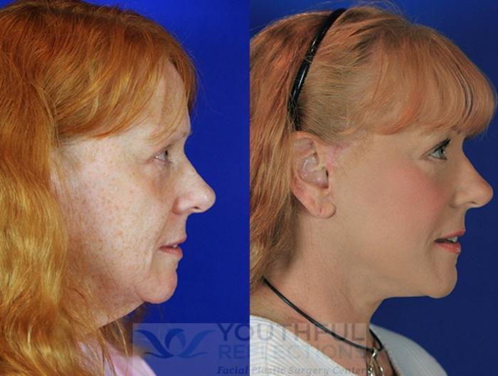 Facelift / Reflection Lift Case 3 Before & After Right Side | Nashville, TN | Youthful Reflections
