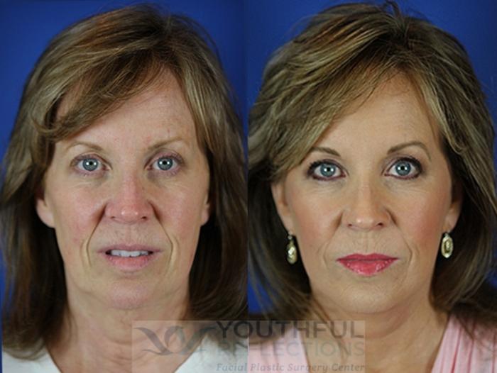 Facelift / Reflection Lift Case 30 Before & After Front | Nashville, TN | Youthful Reflections