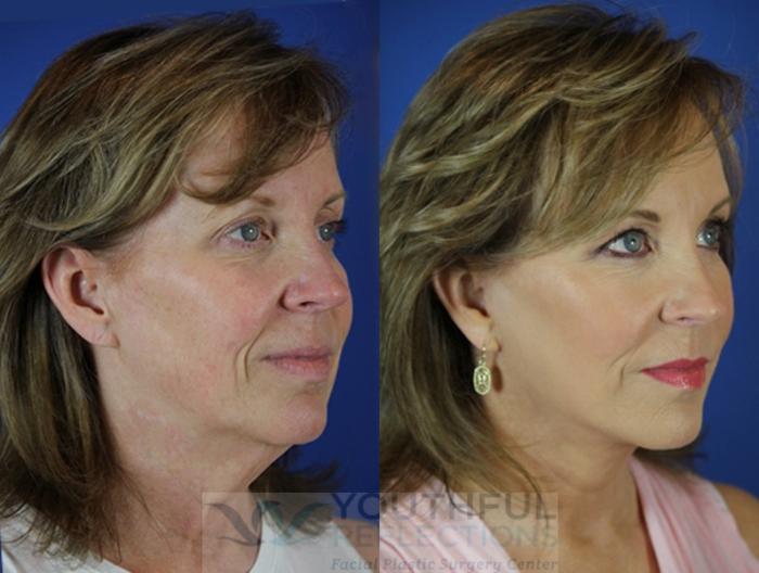 Facelift / Reflection Lift Case 30 Before & After Right Oblique | Nashville, TN | Youthful Reflections