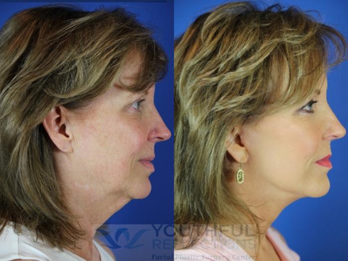 Facelift / Reflection Lift Case 30 Before & After Right Side | Nashville, TN | Youthful Reflections