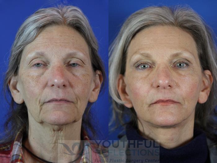 Facelift / Reflection Lift Case 31 Before & After Front | Nashville, TN | Youthful Reflections