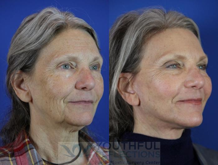 Facelift / Reflection Lift Case 31 Before & After Right Oblique | Nashville, TN | Youthful Reflections