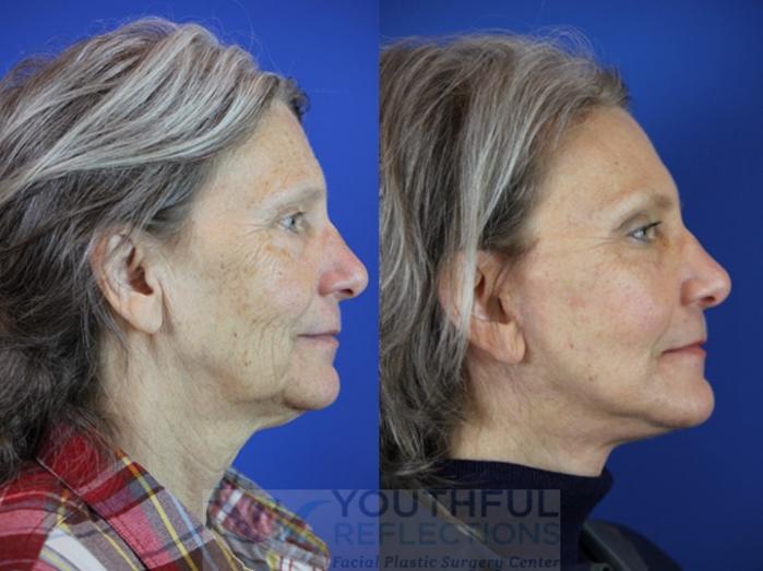 Facelift / Reflection Lift Case 31 Before & After Right Side | Nashville, TN | Youthful Reflections