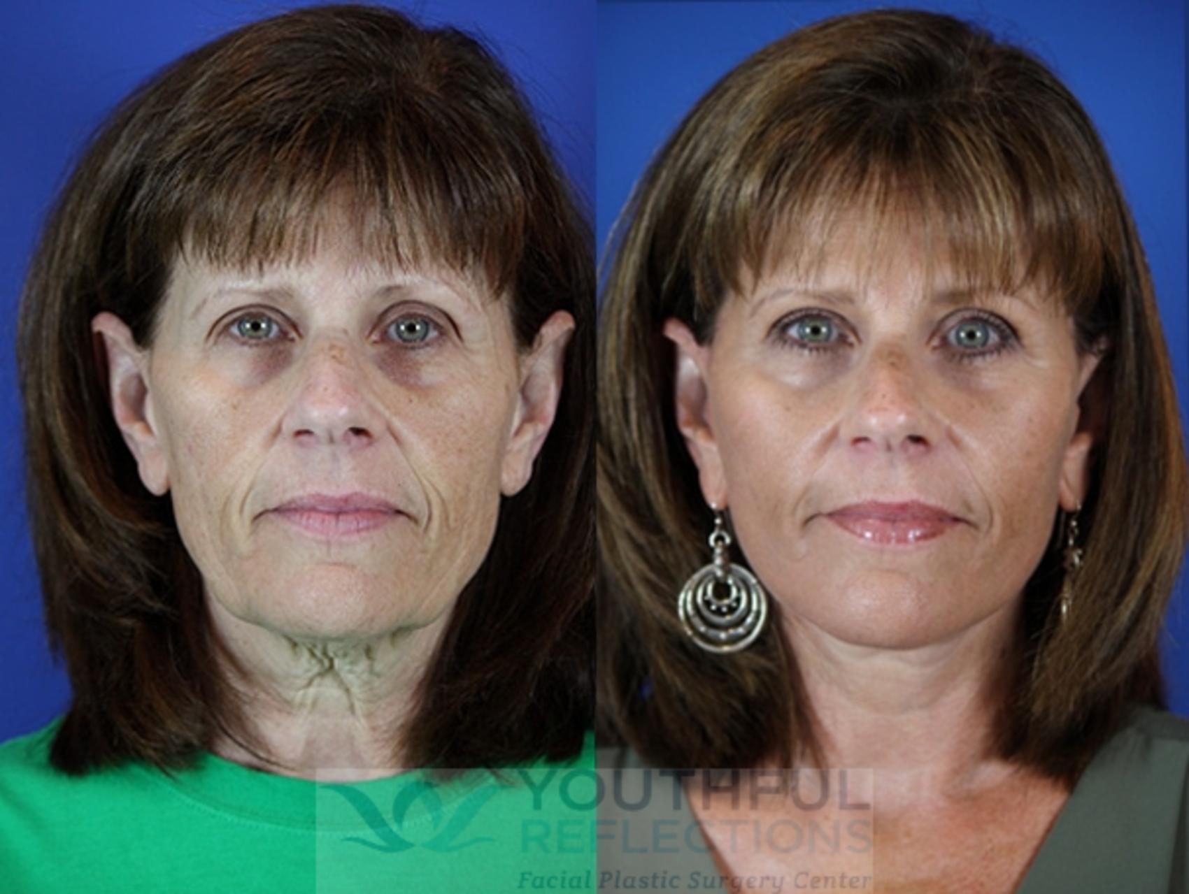 Facelift / Reflection Lift Case 32 Before & After Front | Nashville, TN | Youthful Reflections