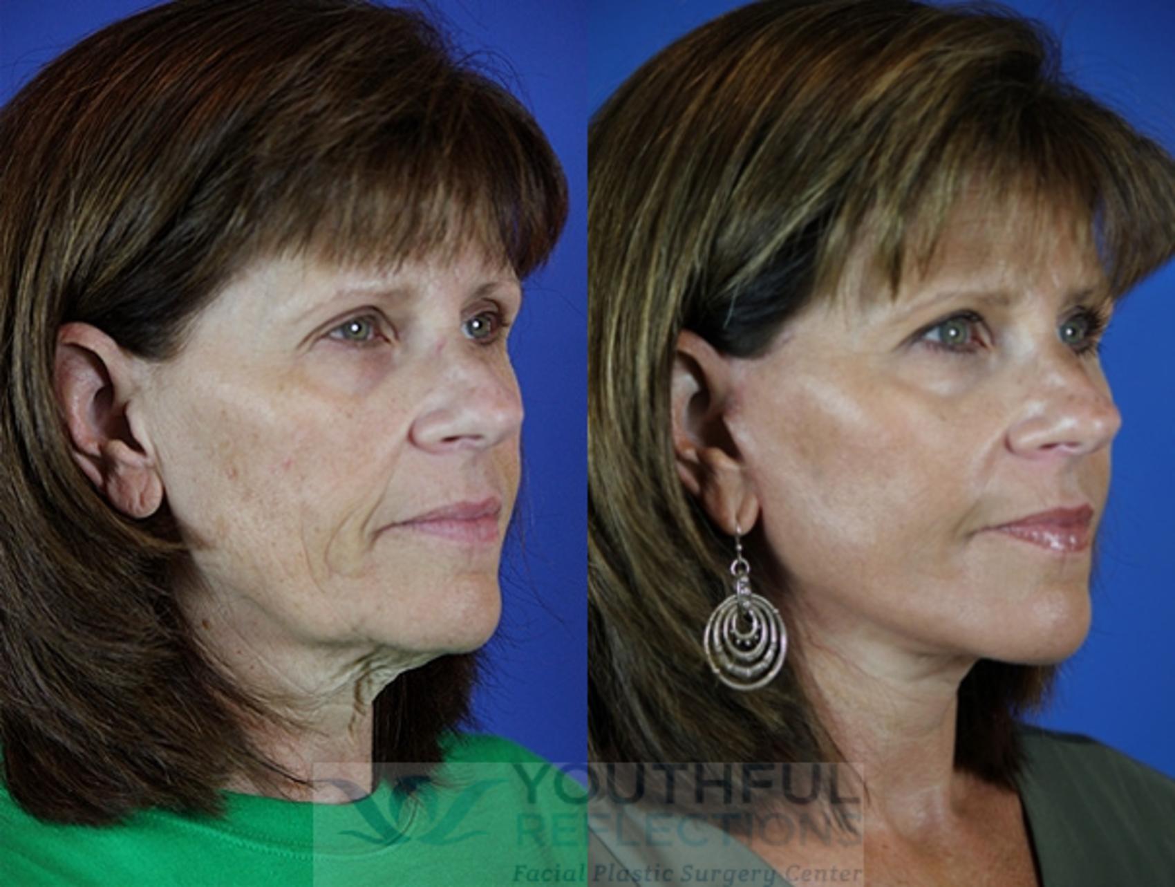 Facelift / Reflection Lift Case 32 Before & After Right Oblique | Nashville, TN | Youthful Reflections