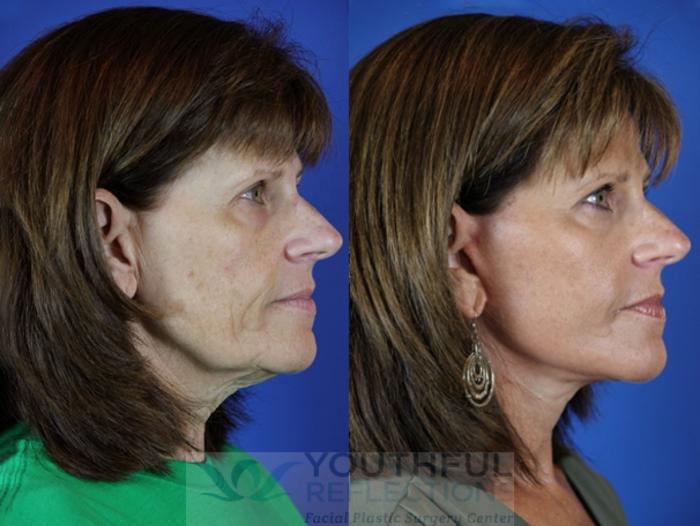 Facelift / Reflection Lift Case 32 Before & After Right Side | Nashville, TN | Youthful Reflections