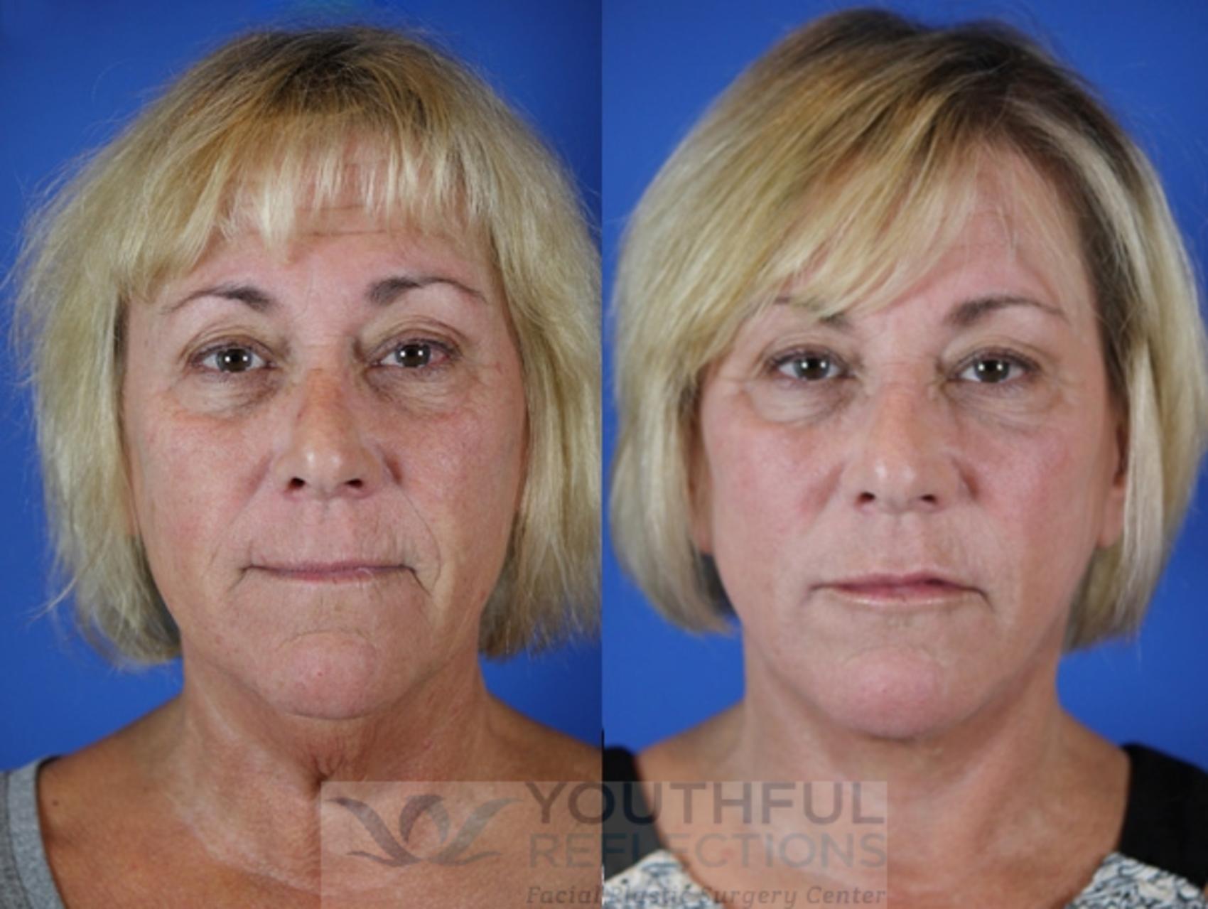 Facelift / Reflection Lift Case 33 Before & After Front | Nashville, TN | Youthful Reflections