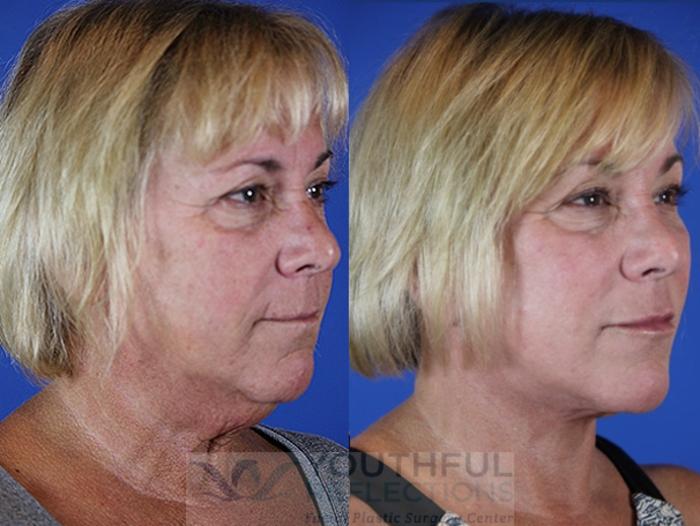 Facelift / Reflection Lift Case 33 Before & After Right Oblique | Nashville, TN | Youthful Reflections
