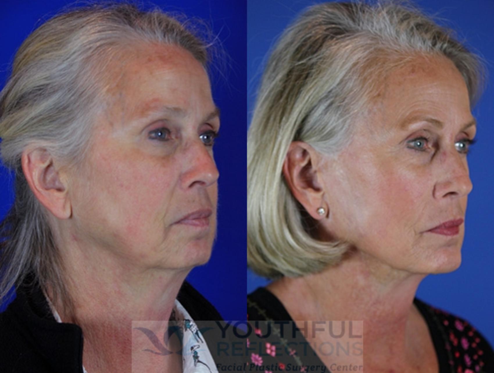 Facelift / Reflection Lift Case 34 Before & After Right Oblique | Nashville, TN | Youthful Reflections