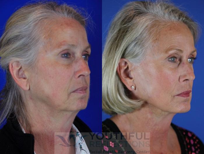 Facelift / Reflection Lift Case 34 Before & After Right Oblique | Nashville, TN | Youthful Reflections