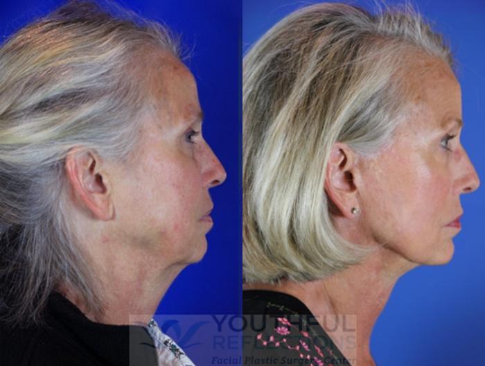 Facelift / Reflection Lift Case 34 Before & After Right Side | Nashville, TN | Youthful Reflections