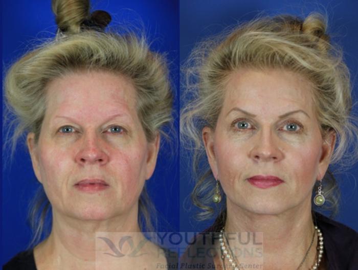 Facelift / Reflection Lift Case 35 Before & After Front | Nashville, TN | Youthful Reflections
