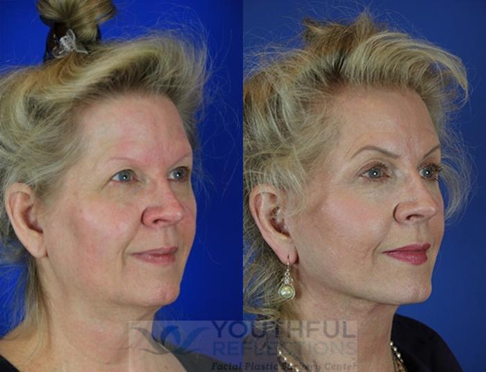 Facelift / Reflection Lift Case 35 Before & After Right Oblique | Nashville, TN | Youthful Reflections