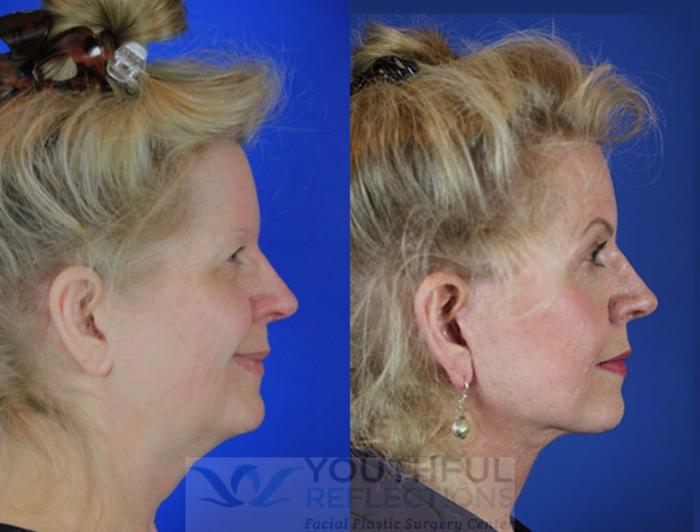 Facelift / Reflection Lift Case 35 Before & After Right Side | Nashville, TN | Youthful Reflections