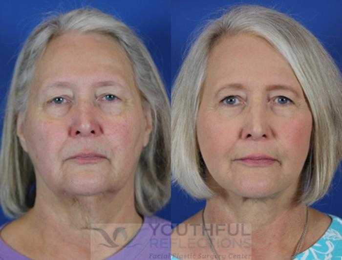 Facelift / Reflection Lift Case 36 Before & After Front | Nashville, TN | Youthful Reflections