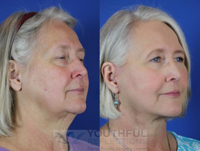 Facelift / Reflection Lift Case 36 Before & After Right Oblique | Nashville, TN | Youthful Reflections