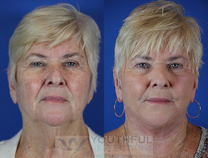 Facelift / Reflection Lift Case 37 Before & After Front | Nashville, TN | Youthful Reflections