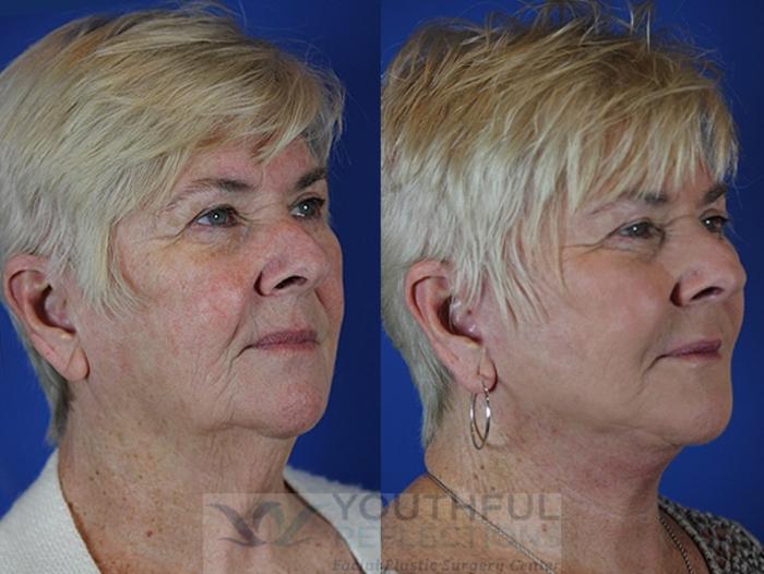 Facelift / Reflection Lift Case 37 Before & After Right Oblique | Nashville, TN | Youthful Reflections