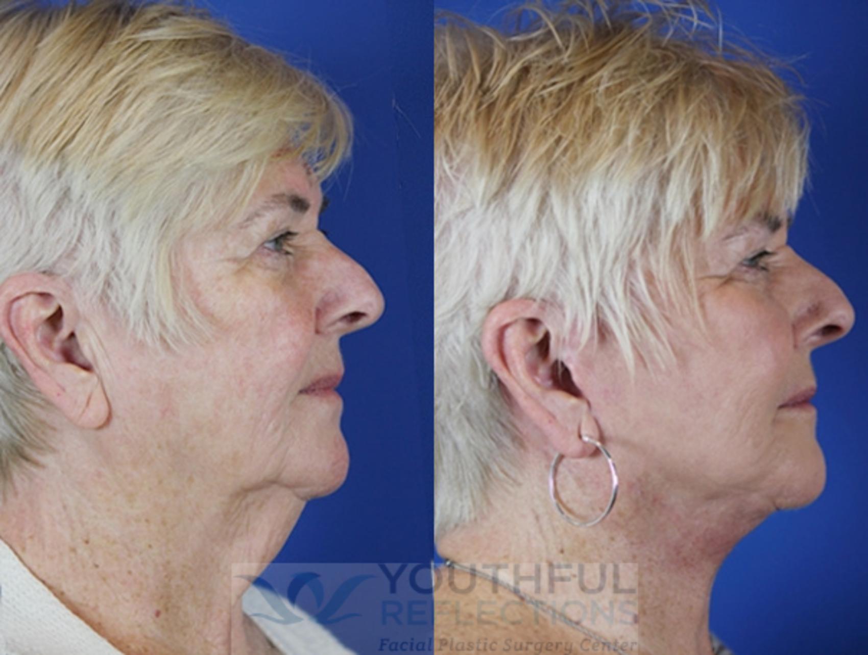 Fat Transfer Case 37 Before & After Right Side | Nashville, TN | Youthful Reflections